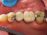 Multiple Implant Crowns
