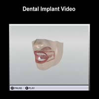 3D Implant Video