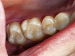 White Fillings After